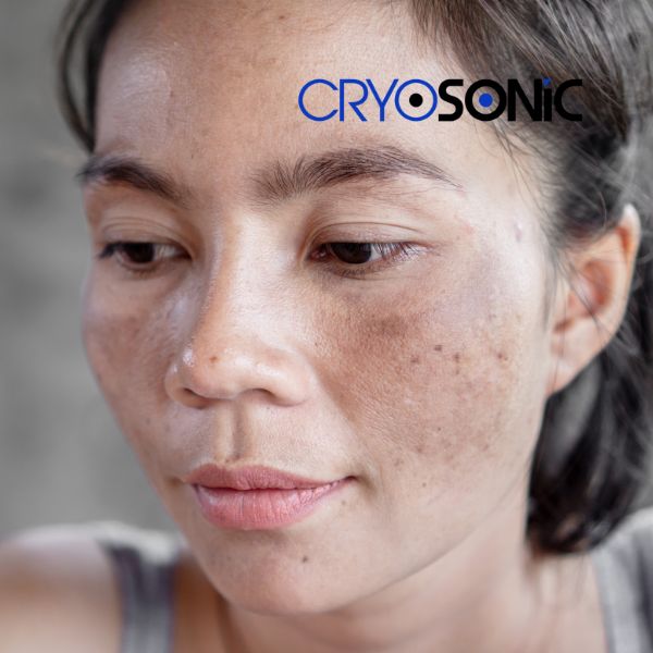 Ready to start age spots removal? Contact our team today in Cambridge