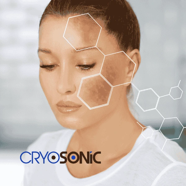 Are you looking for age spot removal treatment? Contact Cryosonic today in Cambridge