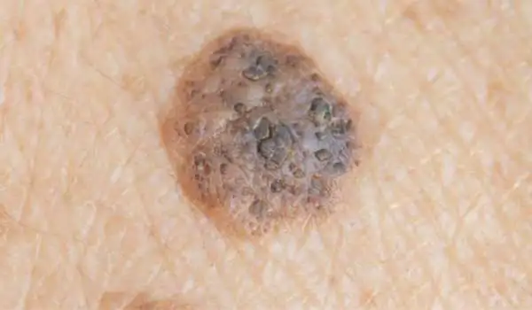 Seborrhoeic Keratosis: Benign vs Malignant Cambridge