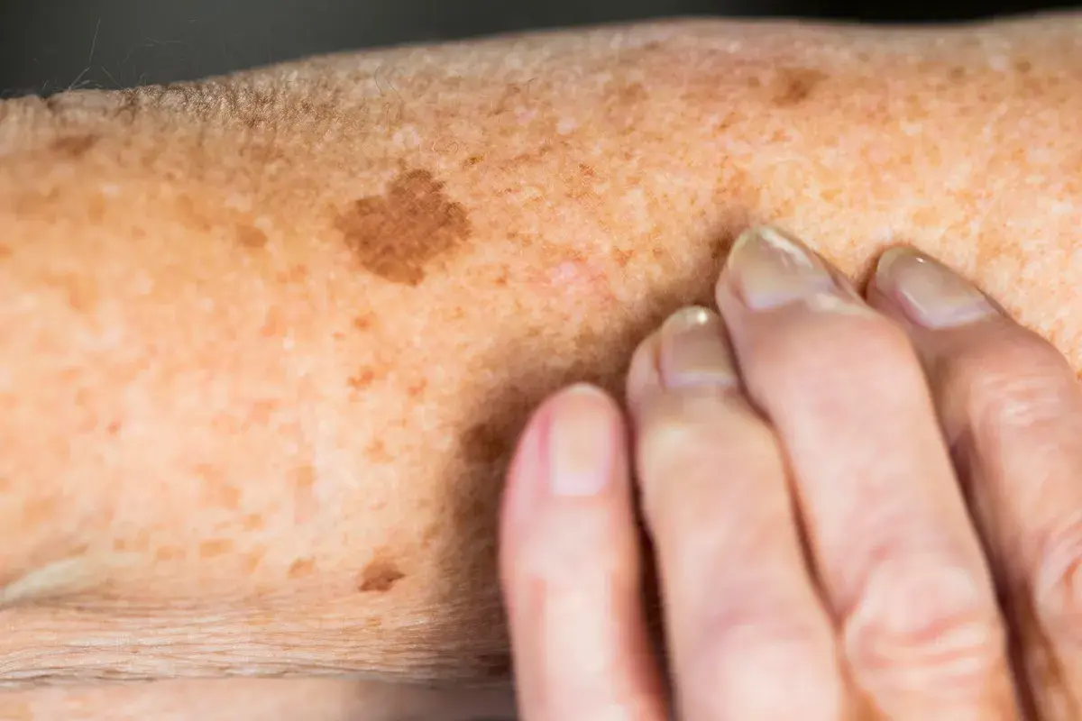 Sun Damage Aftercare and Skin Recovery Cambridge