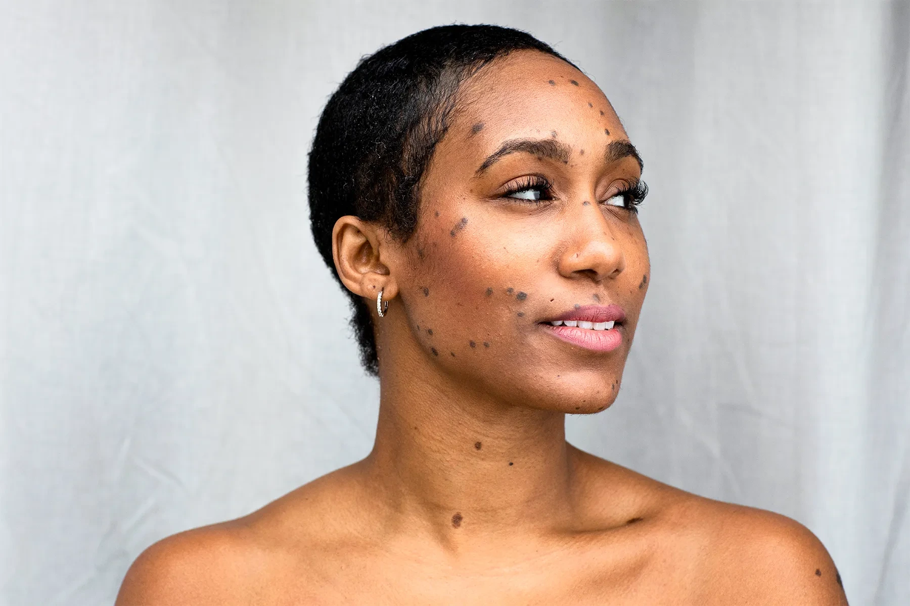 Dermatosis Papulosa Nigra on darker skin treated with Cryosonic CryoPen, showing genetic factors and effective removal Cambridge
